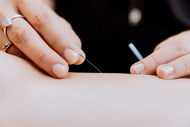 Japanese-style acupuncture treatment Miami