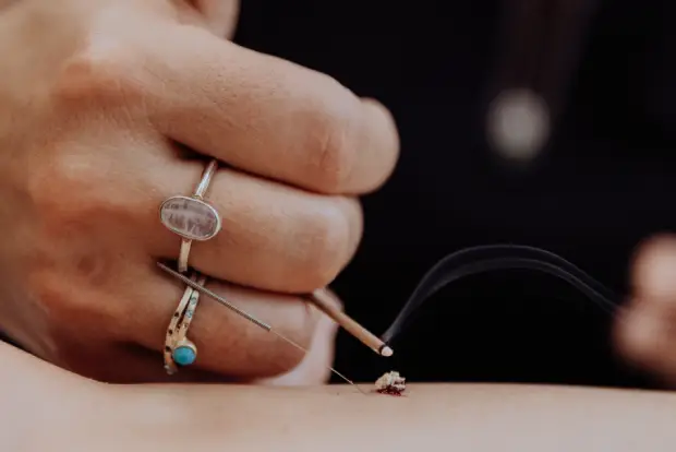 Japanese Okyu moxibustion technique Miami