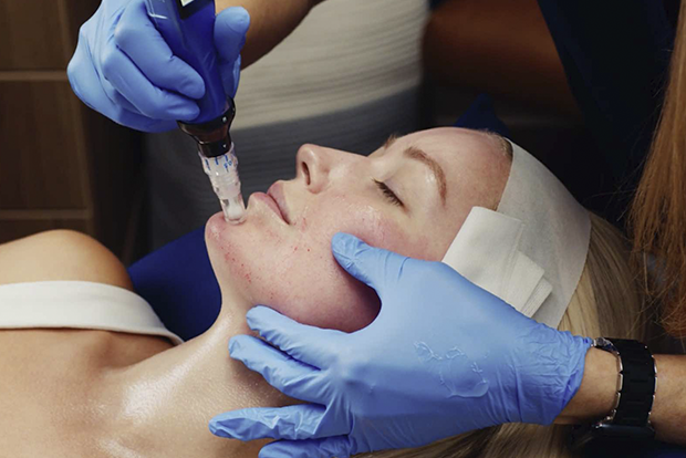 NanoNeedling treatment session Miami