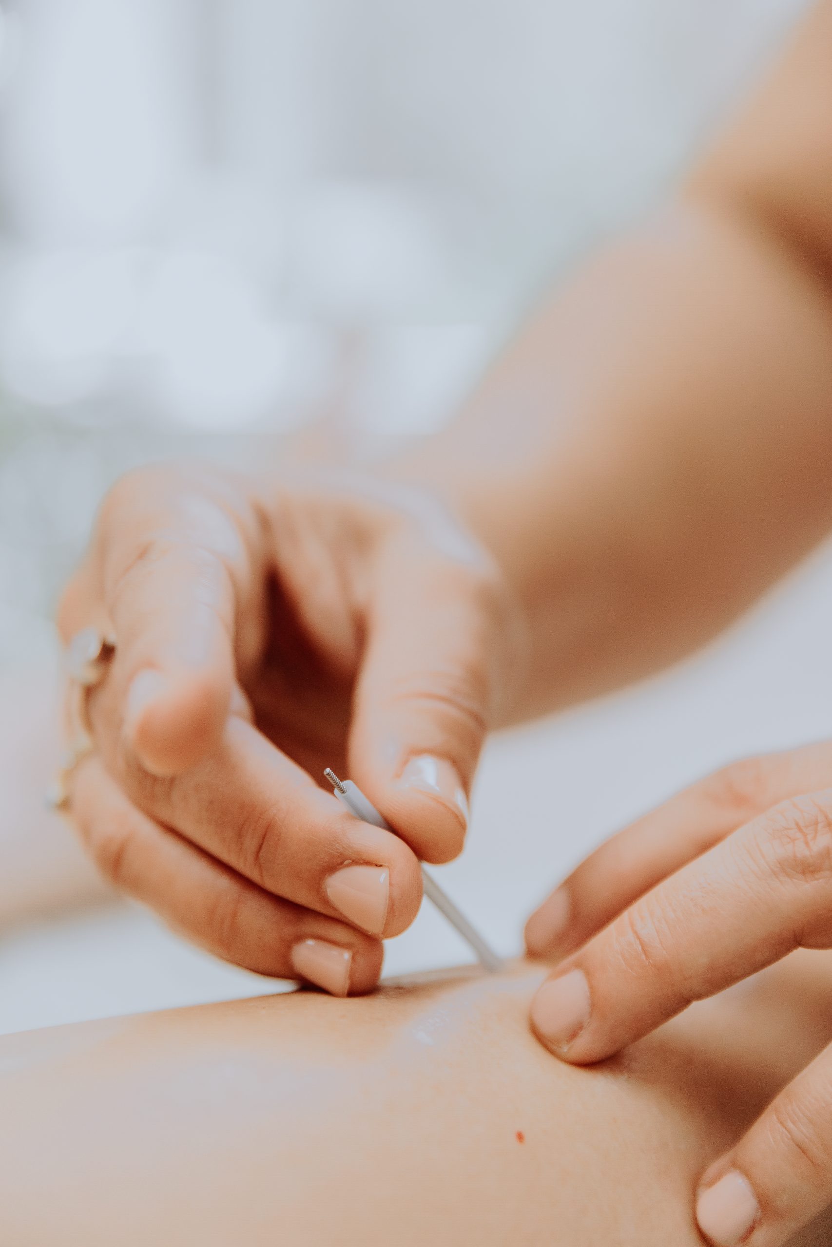 What is acupuncture — Japanese-style acupuncture treatment at Treehouse Miami