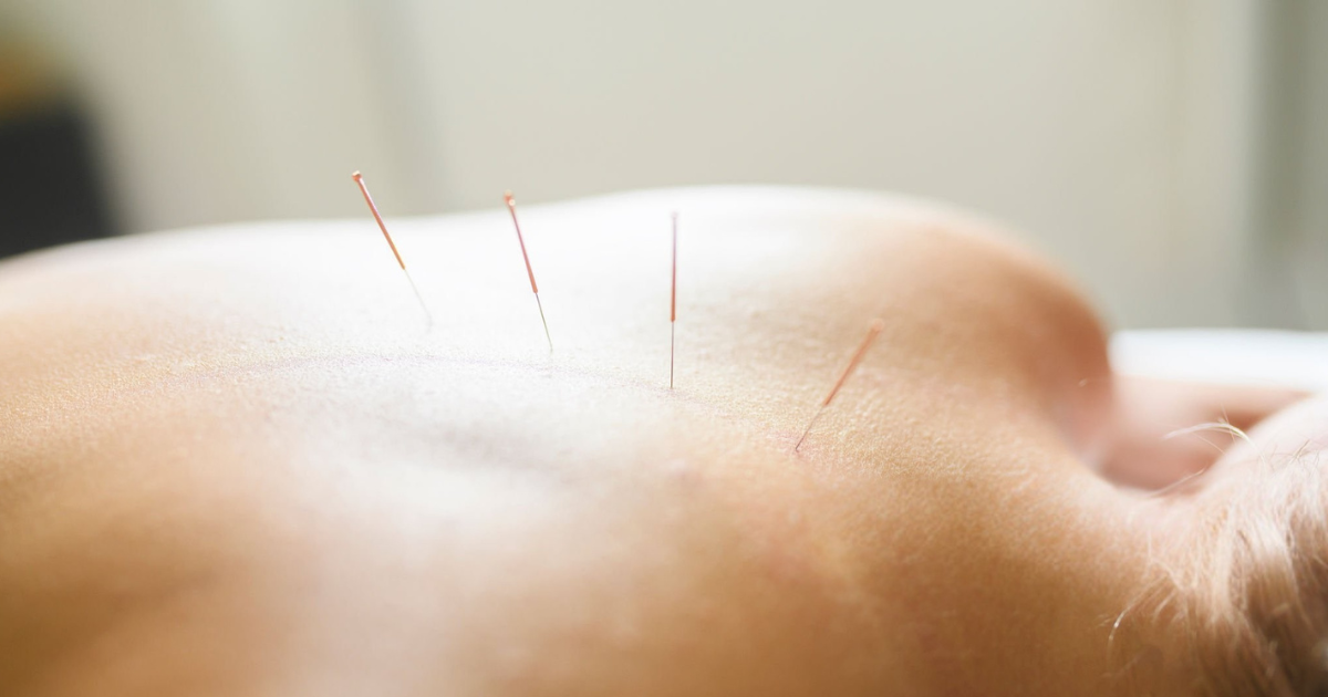 Fine needle acupuncture insertion — Japanese-style Kiiko Matsumoto technique at Treehouse Acupuncture Miami
