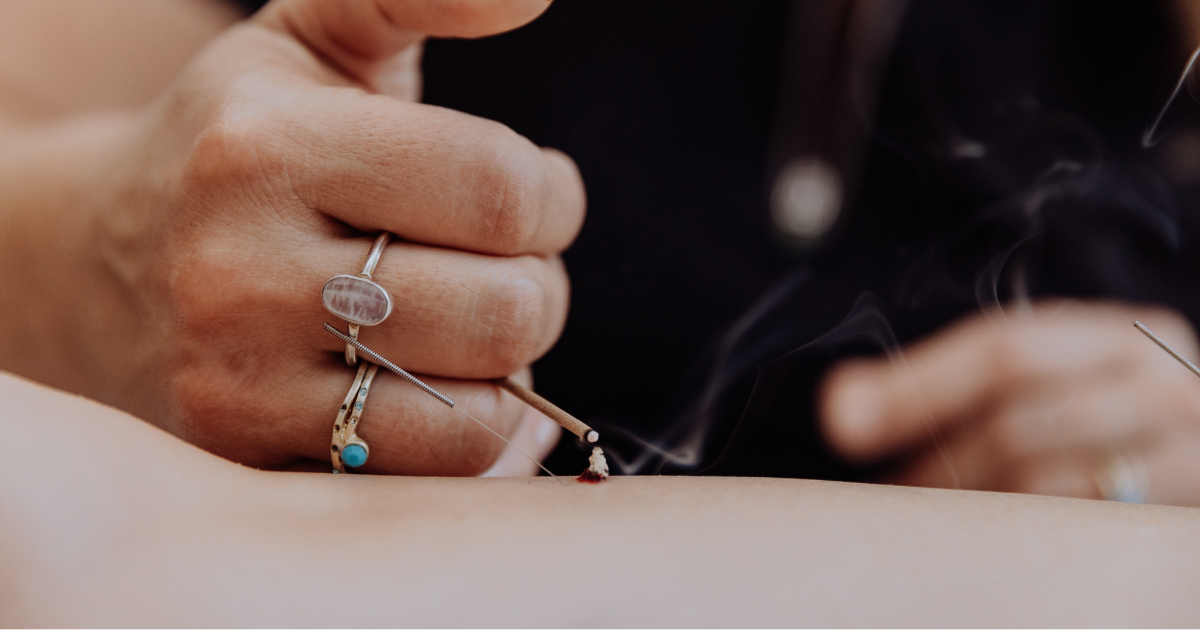 Hands performing Okyu moxibustion on skin — Japanese thread-moxa technique at Treehouse Acupuncture Miami